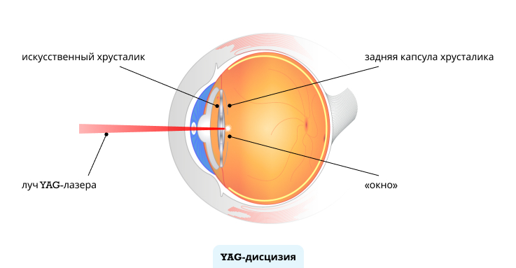 YAG-лазерная дисцизия вторичной катаракты