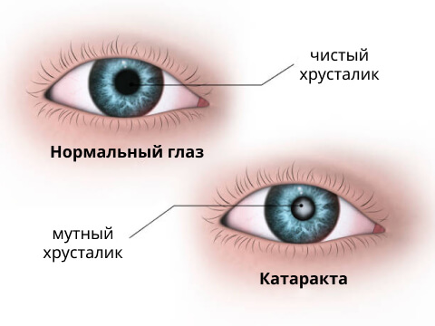 Как выглядит глаз с катарактой