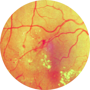 Диабетическая ретинопатия: препролиферативная форма
