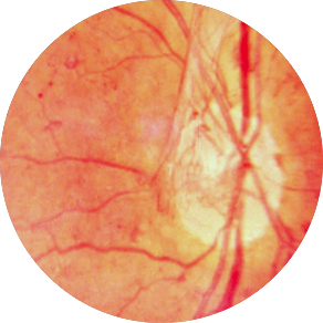 Диабетическая ретинопатия: пролиферативная форма
