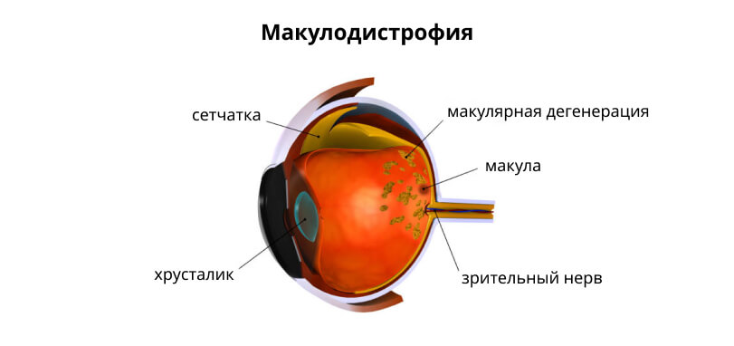 Макулодистрофия сетчатки: строение глаза