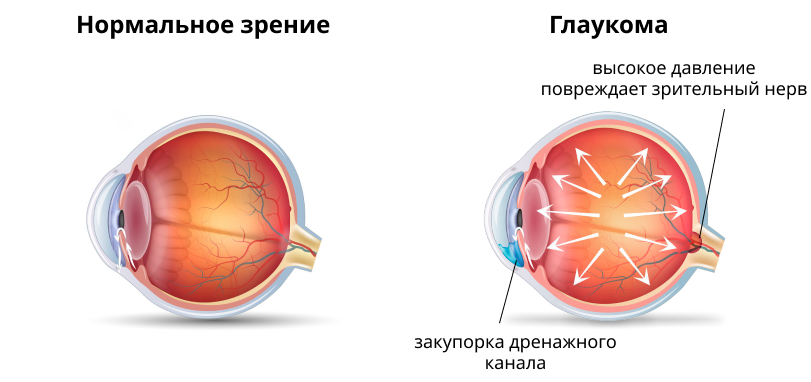 Глаукома: строение глаза