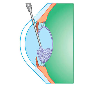 Операция по удалению катаракты: этап 1