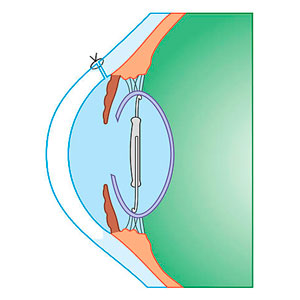 Факоэмульсификация катаракты с имплантацией ИОЛ: этап 2