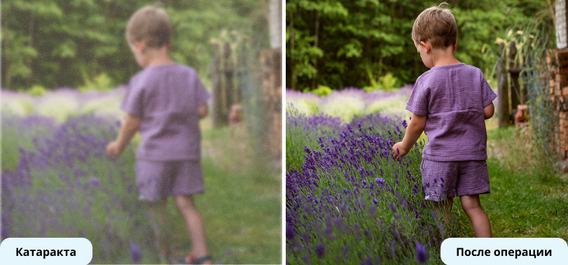 Интраокулярная линза Clareon PanOptix (Alcon)